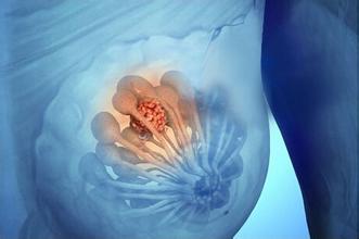 乳腺纤维瘤的危害有哪些