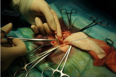 乳腺纤维瘤需要手术吗