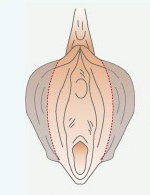 小阴唇肥大是天生的吗