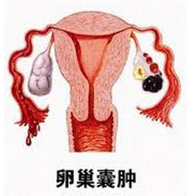 卵巢肿瘤是如何诊断的