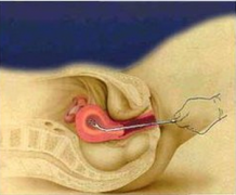 做清宫需要多少钱