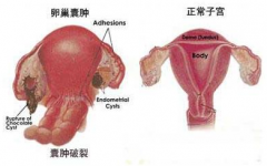 治疗卵巢囊肿的检查和治疗