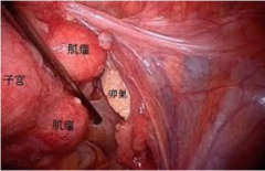 治疗子宫肌瘤需要多长时间