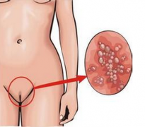 盆腔炎多长时间能治好