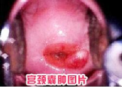 得了宫颈囊肿多长时间能治好