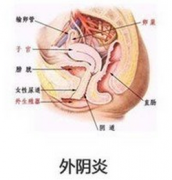 治疗外阴炎有哪些方法