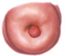 治疗宫颈息肉需要多长时间