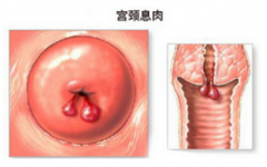宫颈息肉的检查和治疗