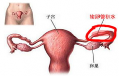输卵管有积水会导致女性不孕吗