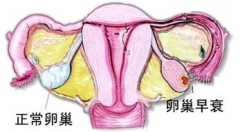 卵巢早衰可以怀孕吗