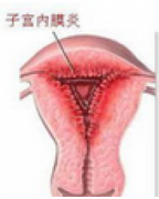 如何预防子宫内膜炎