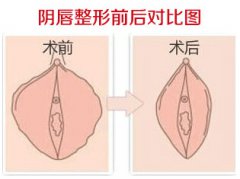 大阴唇怎么整形