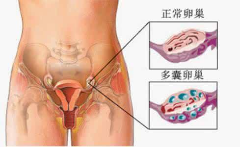 多囊卵巢的危害